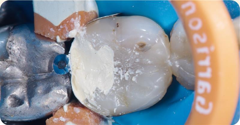 Banner Renner - pulpotomy jpg