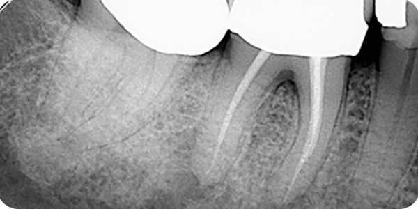 Case Study: Root Canal Retreatment