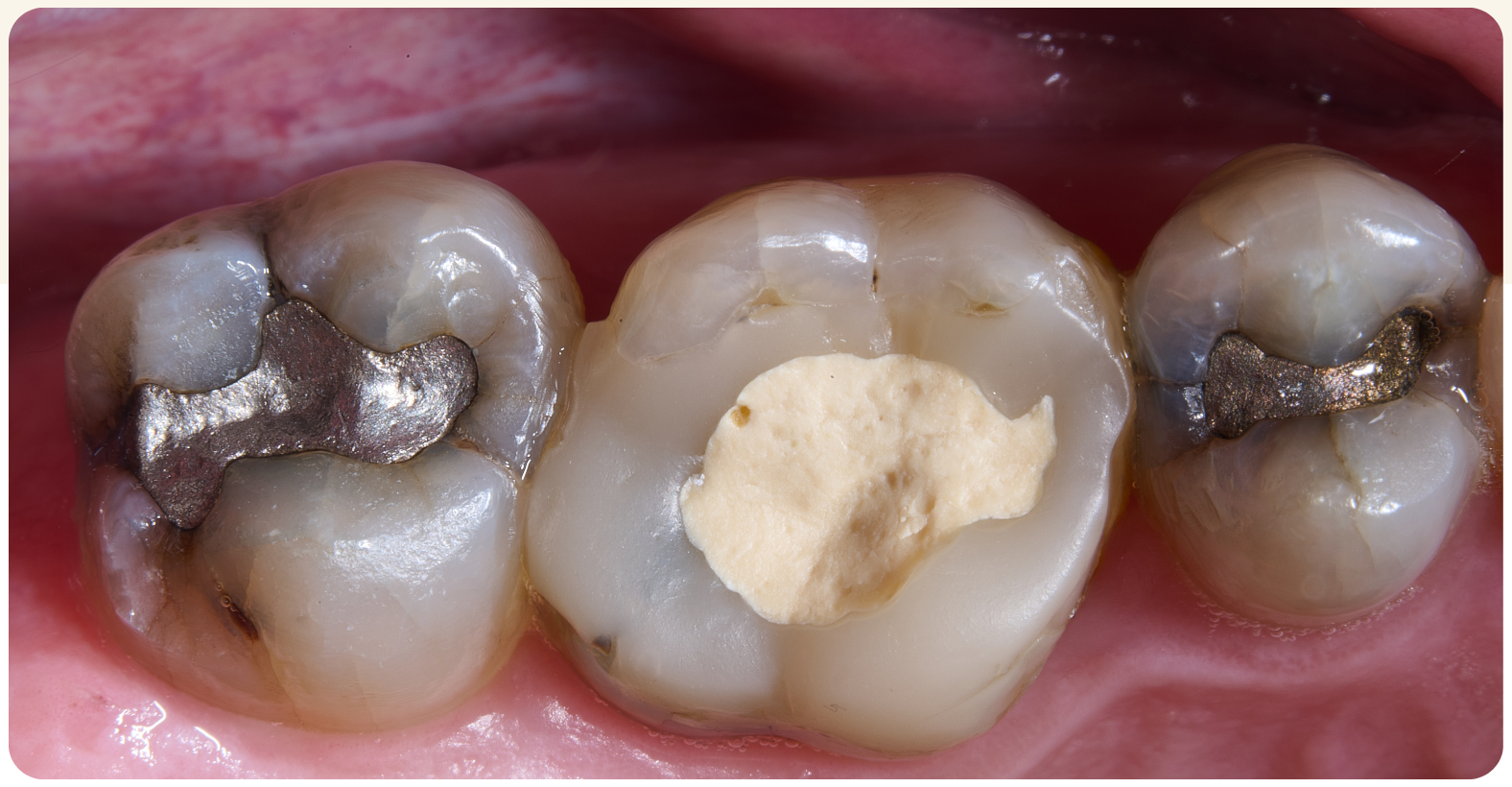 Banner-Case-Study-Dr.-Renner-Cracked Teeth