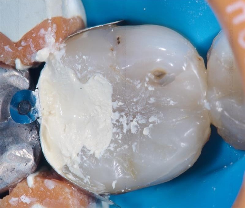 Preview picture - pulpotomy case renner