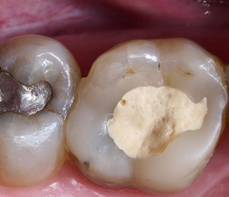 Preview picture LP_ cracked teeth